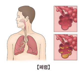 폐렴의 예시