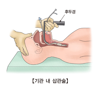 후두경을 기관내 삽관하는 예시