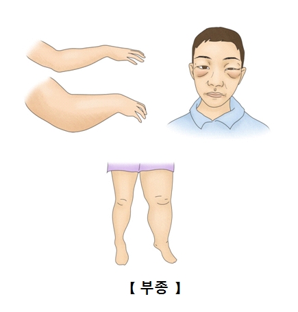 팔 눈주변 다리쪽 부종이 발생한 예시