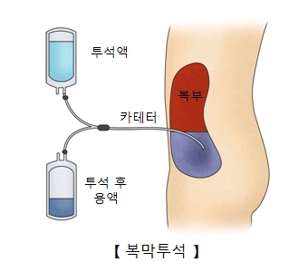 투석액을 카테터를 통해 복부쪽으로 투입하여 투석후 용액을 받아내는 복막투석의 예시