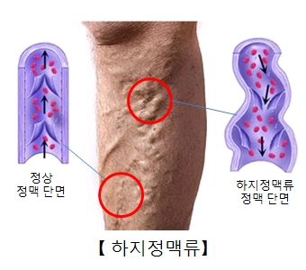 하지 정맥류 | 질환백과 | 의료정보 | 건강정보 | 서울아산병원