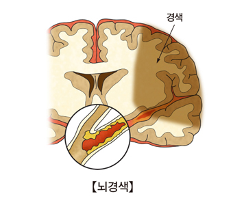 경색및 뇌경색의 예시