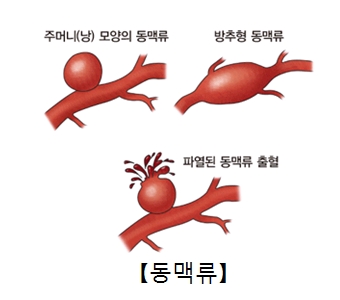 주너미(냥)모양의 동맥류 방추형 동맥류 파열된 동맹류 출혈등 동맹류의 종류