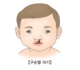 구순열로 윗입술이 갈라진 아기