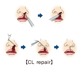 CL repair의 예시