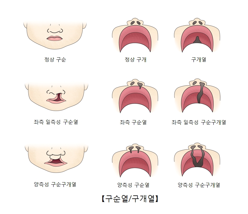 정상구순의 정상구개 구개열의 모습과 좌측 일측성 구순열의 좌측구순열 좌측 일측성 구순구개열의 모습과 양층성 구순구개열의 양층성 구순열 양층성 구순구개열의 모습의 대한 예시