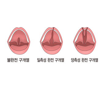 불완전 구개열 일측성 완전 구개열 양측성 완전 구개열의 대한 예시