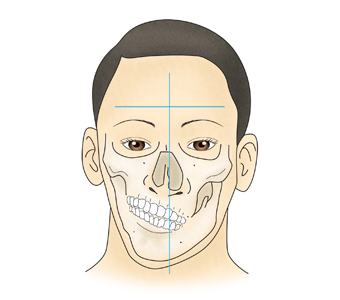 안면비대칭의 예시