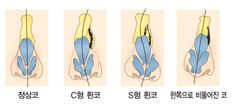 정상코 C형휜코 S형 휜코 한쪽으로 삐뚫어진 코의 예시