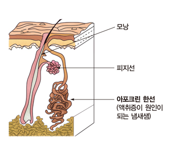 모낭 피지선 아포크린 한성(액취증이 원인이 되는 냄새샘)의 위치 예시