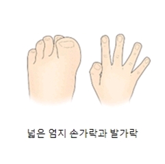 거대지증의 대한 예시