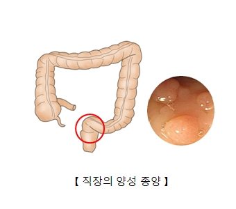 직장의 양성종양의 예시