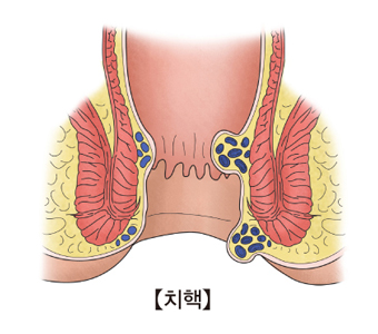 치핵의 예시