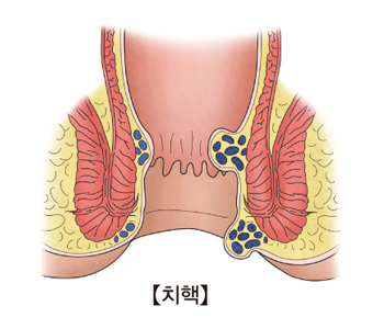 치핵의 예시