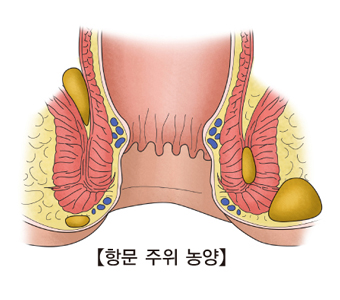 항문주위 농양의 대한 예시