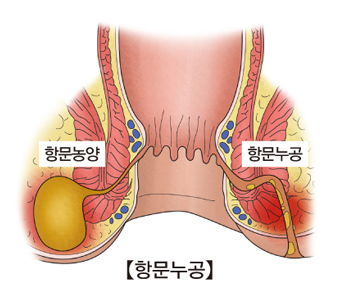 항문농양및 항문누공의 대한 예시