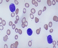 급성 림프모구성 백혈병 세포의 예시