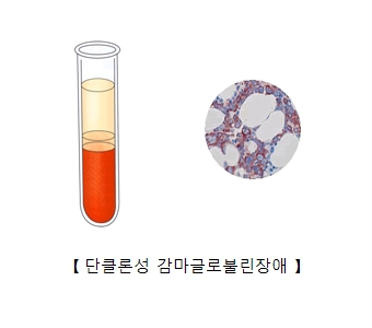 단클론성 감마글로불린장애의 예시