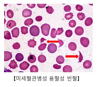 미세혈관병성 용혈성 빈혈의 예시