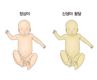 정상아와 황달이 발생한 신생아 황달의 차이점 예시