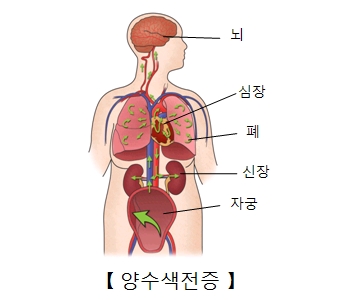 뇌 심장 폐 신장 자궁등 양수색전증의 예시 