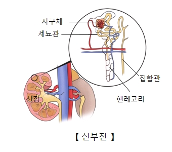 신장안쪽 사구체 세뇨관 집합관 헨레고리등으로 이루워진 신부전의 예시