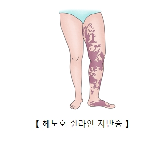 헤노호 쉰라인 자반증이 발생된 다리의 예시