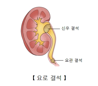 신우결석 요관결석 등 요로결석의 예시