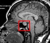 뇌의 뇌하수체 MRI 사진