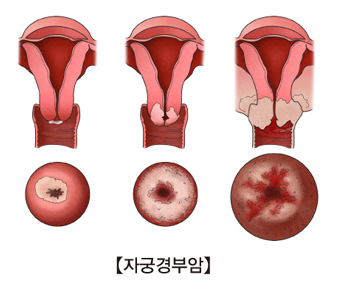 자궁경부암의예시