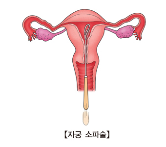 자궁 소파술의 예시