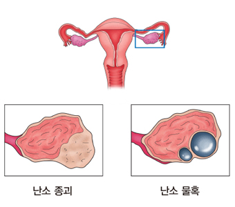 난소 종괴 난소물혹등 난소암의 예시