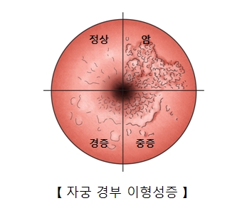 정상 암 경증 중증등 자궁경부 이형성증의 차이의 예시