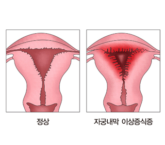 정상자궁내막과 자궁내막 이상증식증에 걸린 자궁내막 그림 예시