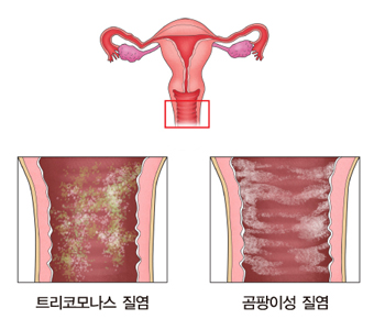 트리코모나스질염 곰팡이성 질염의 그림 예시