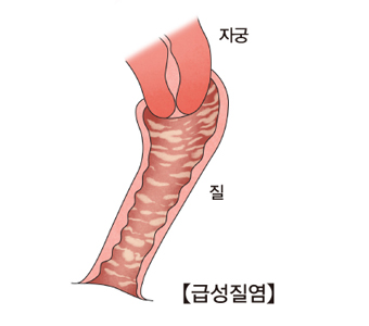 급성질염에 감염된질과자궁