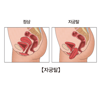 정상 자궁위치와 자궁탈증에 걸린 자궁위치 그림 예시