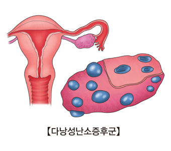 다낭성난소증후군 그림 예시