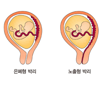 은폐형 박리와 노출형 박리 그림 예시