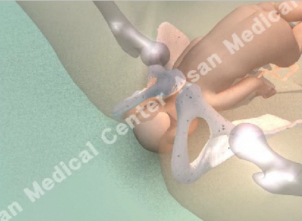 자궁을 통해 태아의 머리가 나오는 모습(입체 3D) 그림 예시
