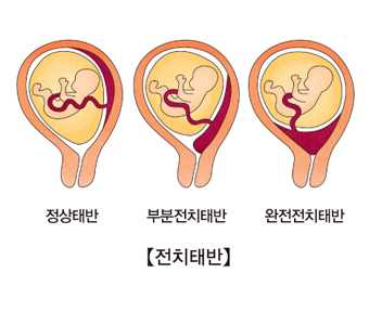 전치태반-정산태반,부분전치태반-완전전치태반의 그림 예시