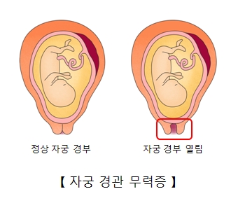 자궁경관 무력증-정상자궁경부와 열려있는 자궁경부의 그림 예시