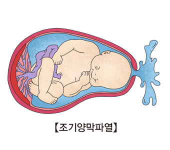 조기양막파열 그림 예시