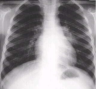 폐결핵 검사를 위해 찍은 흉부 X-ray