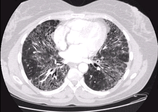 미만성 간질성 폐질환 확인을 위한 x-ray사진
