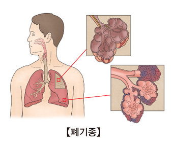 폐 위치에 따라 폐기종을 나타낸 예시