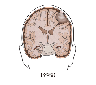 뇌의단면도로본 수막종