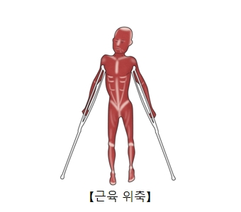 근육위축으로인해 목발 의지하고 있음