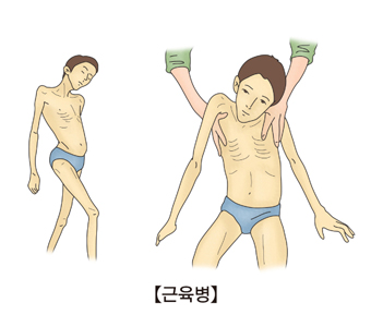 신체장애로불편하게걷는모습과 혼자서일어나지못하고 부축 받고있는 남성의 모습