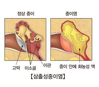 삼출성중이염 정상중이의 고막,이소골,이관의 위치와 중이염에발병한 중이 안에 화농성액이 있는 사진예시